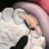 eFiber Single Tooth Replacement