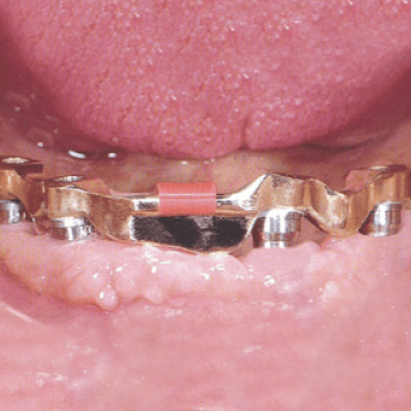 Revax Hybrid Implant Bar