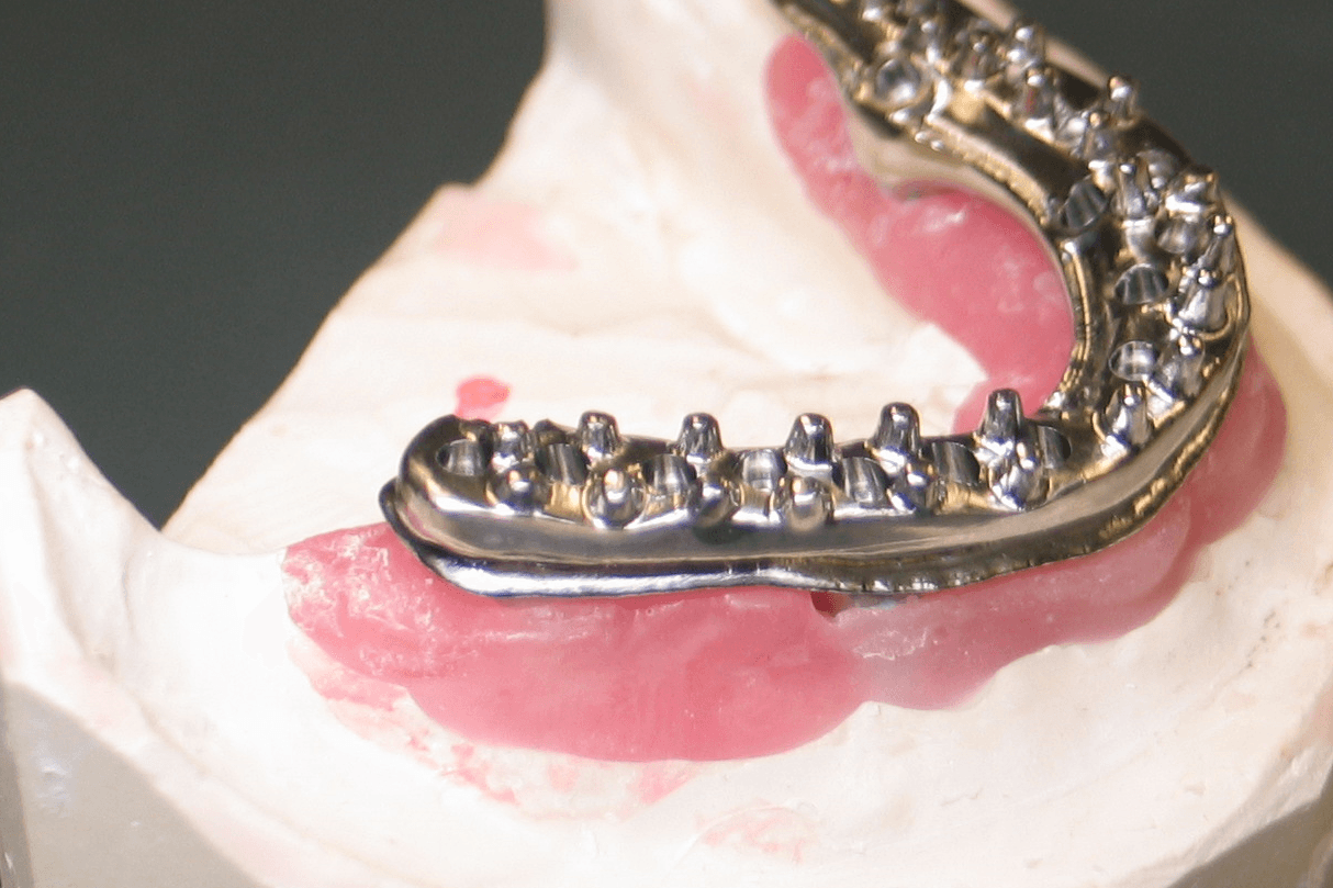 Hybrid with Facial/Buccal finish line.