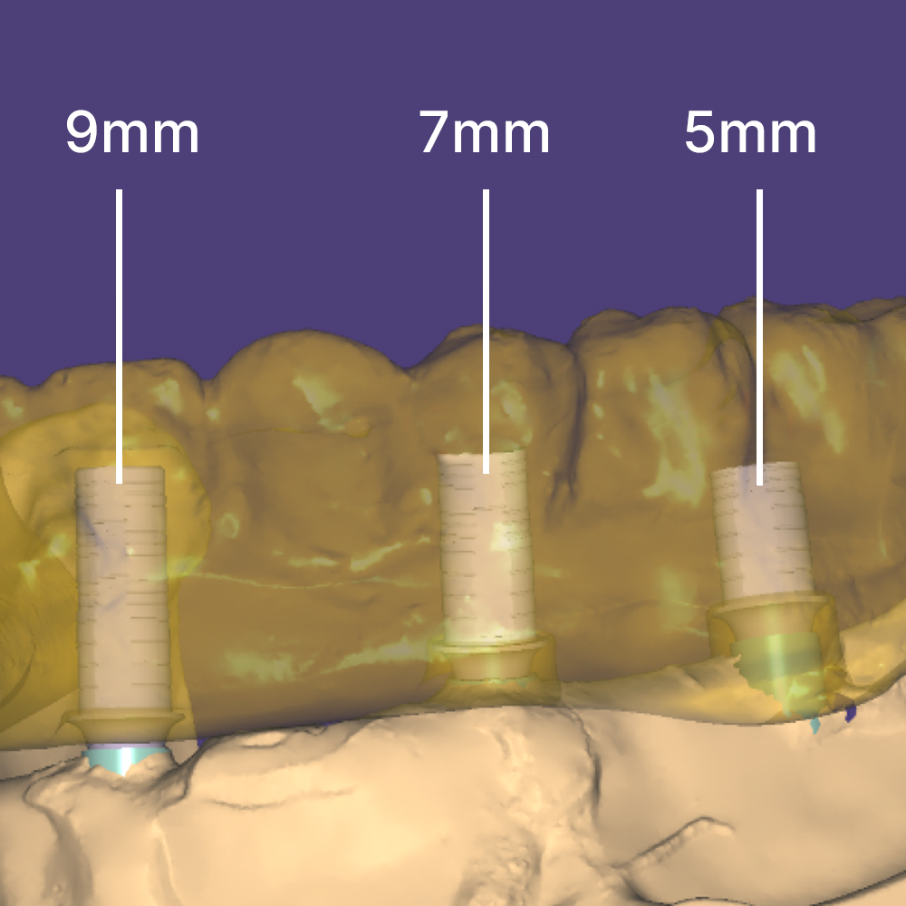 The CAD software will populate images(s) of the implant connecting component.