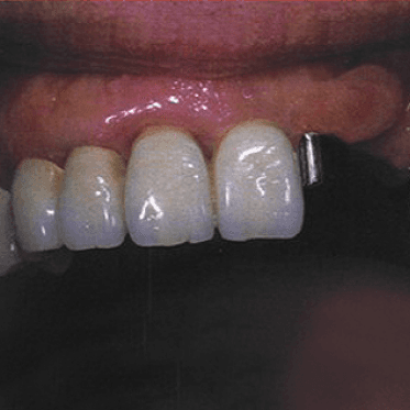 Vertix "P" Attachment