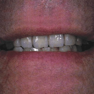 Vertix "P" Attachment