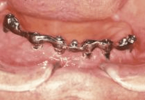 Clix Ball Attachment