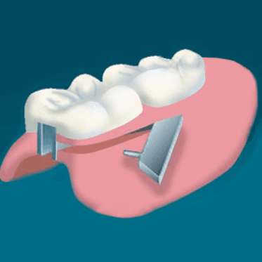 Mays Unilateral Attachment