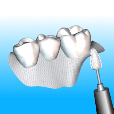 Fiber Technology Proper Placement