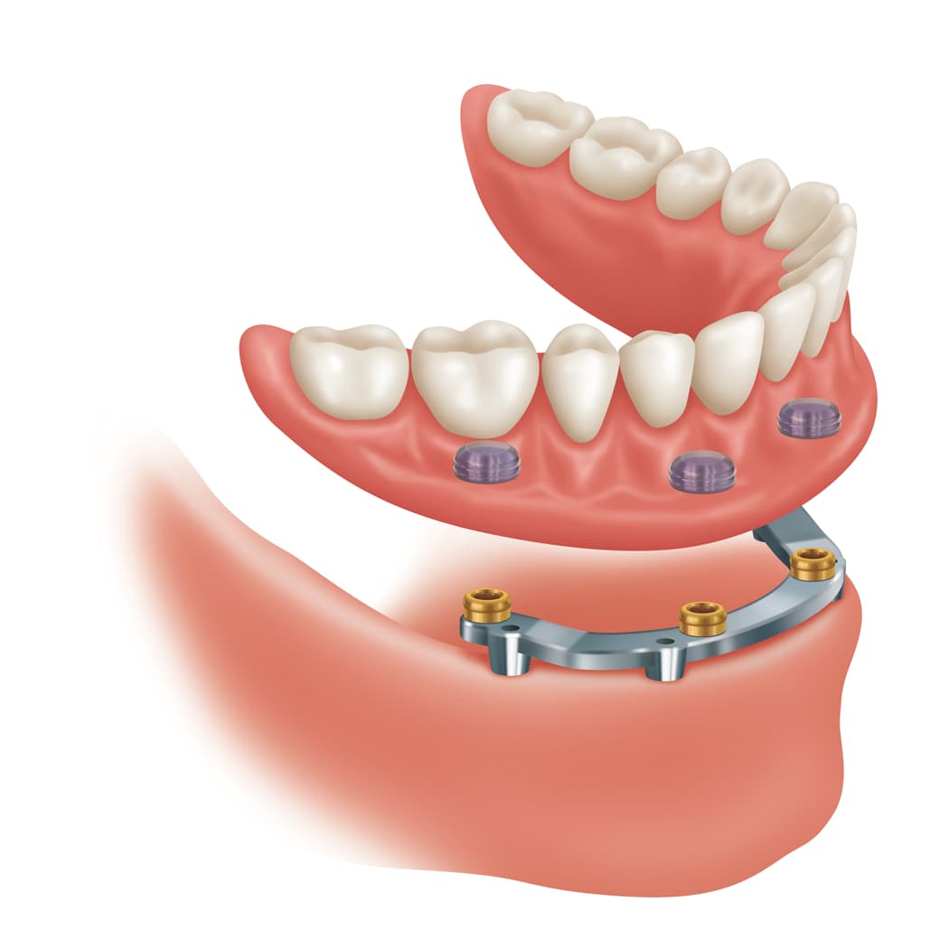 LOCATOR® Bar Attachment