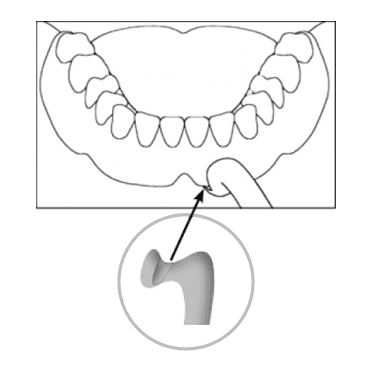 Denture Removal Tool