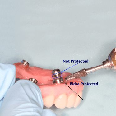 Bidra Conversion Smart Polishing Caps