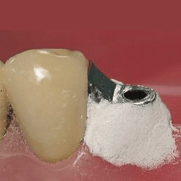 Perma Block - Block Out Material