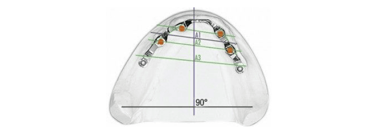 Revax Hybrid Implant Bar