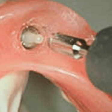 ZAAG Attachment Components