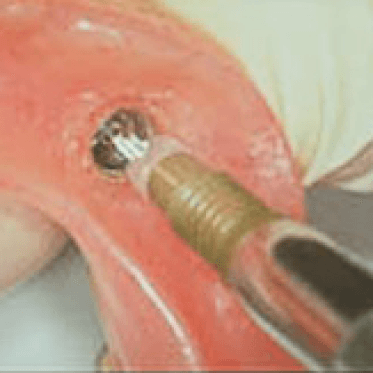 ZAAG Attachment Components