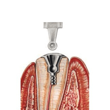 Zest Anchor Direct Placement