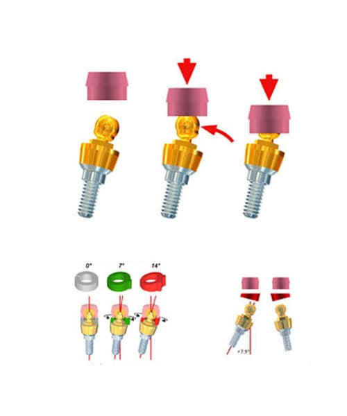 Sphero Flex Implant Abutment (2.5mm)