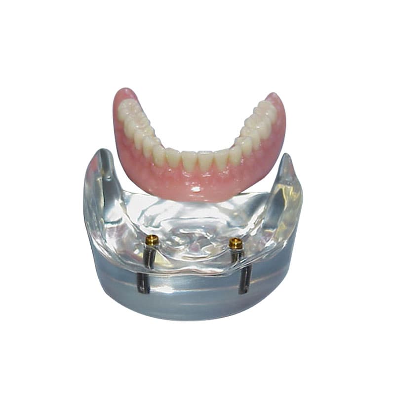 LOCATOR® Implant Model w/External Hex Implants