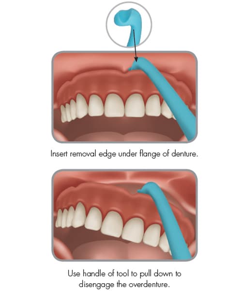 Denture Removal Tool (10-pack) pack of 10 denture removal tools